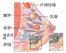 乳腺增生